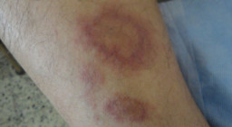 Érythème polymorphe