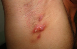 Acné inversa (hidradénite suppurée)