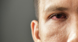 Inflammation de l’iris (iritis)