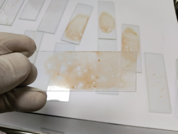 Examen de la moelle osseuse