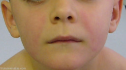 Cinquième maladie (érythème infectieux)