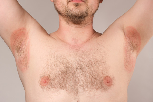 Problèmes de peau sous les bras (aisselles)