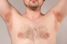 Problèmes de peau sous les bras (aisselles)