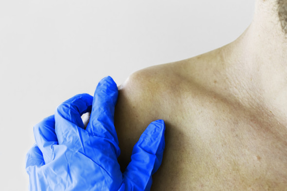 Luxation de l’articulation entre la clavicule et l’omoplate (articulation acromio-claviculaire)