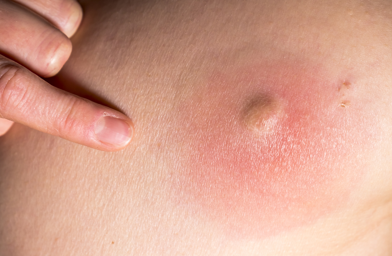 Abcès de la peau (abcès cutané)