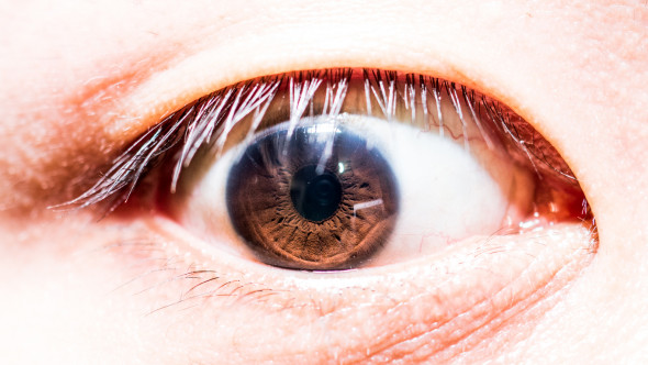 Enroulement du bord de la paupière (entropion et ectropion)