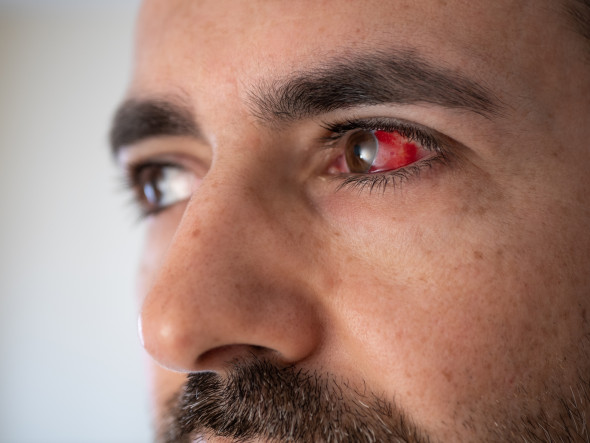 Saignement sur le blanc de l’œil (hémorragie sous-conjonctivale)