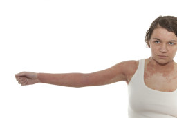 Eczéma atopique (dermatite atopique) chez l’adulte