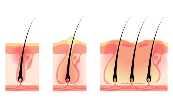 Folliculite et abcès cutané