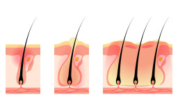 Folliculite et abcès cutané