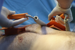 Cardioversion électrique