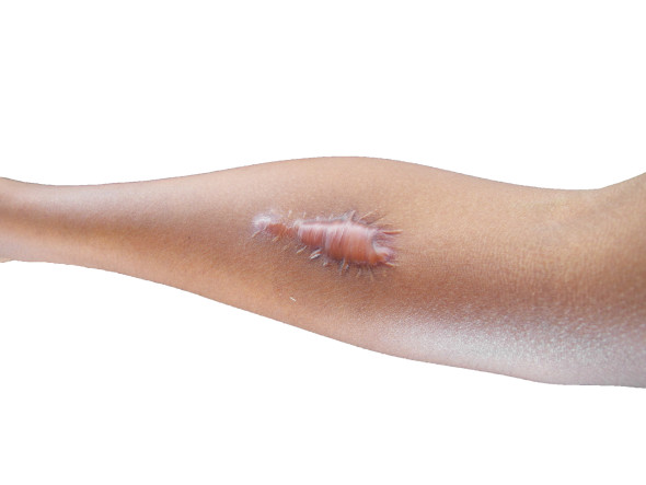 Cicatrice chéloïde