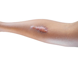 Cicatrice chéloïde