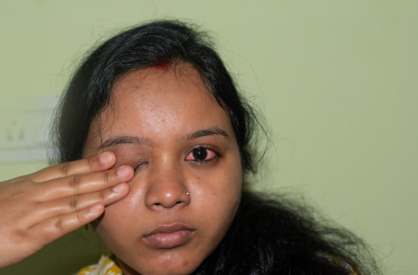 Inflammation de l’épisclère (épisclérite)