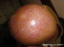 Lupus cutané (lupus érythémateux discoïde)