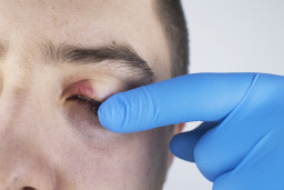 Problèmes de peau aux paupières