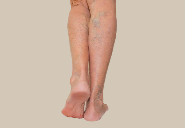 Varices dans les jambes