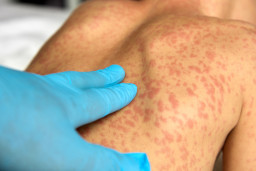 Médicaments et sensibilité à la lumière