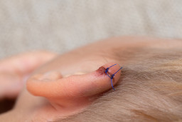 Blessures (traumatismes) du pavillon de l’oreille