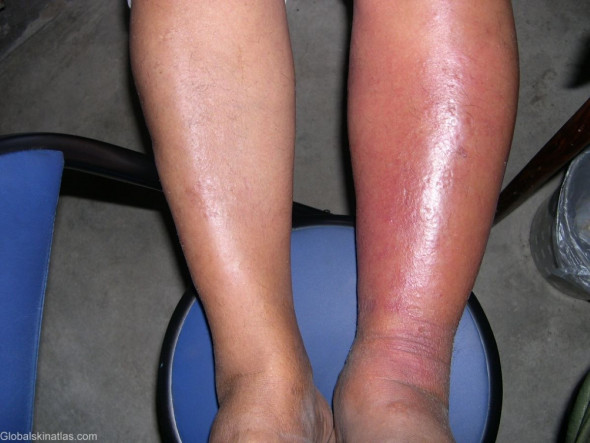 Infections graves de la peau et des tissus mous