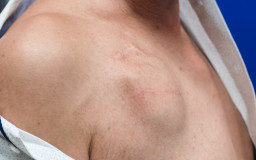 Défibrillateur automatique implantable (DAI)