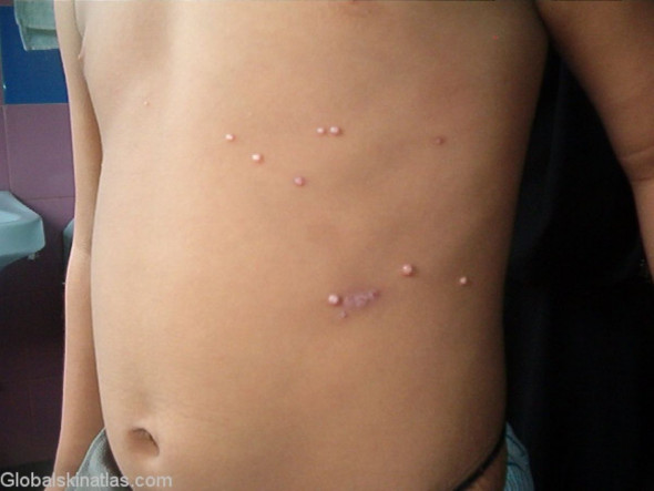 Molluscum contagiosum